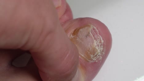 A-cracked-and-discolored-toenail-caused-by-mycosis---fingers-rub-the-sore-toe,-static-macro