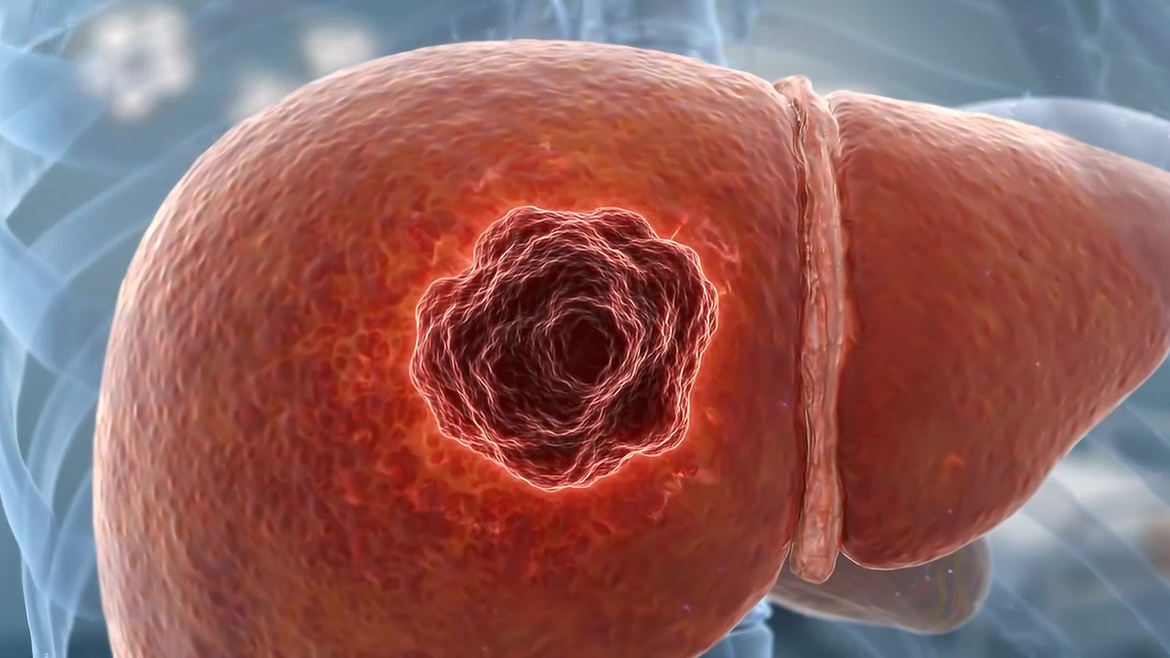 Animation médicale 3D de la croissance tumorale du cancer du foie