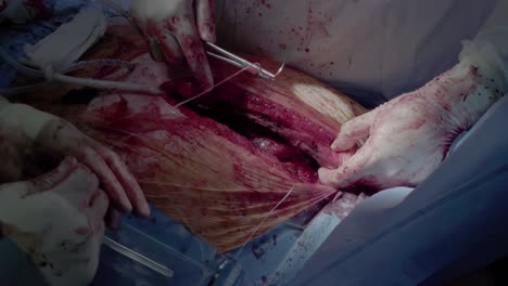 cardiosurgeons perform the stitching of the incision aorto-coronary bypass surgery is performed