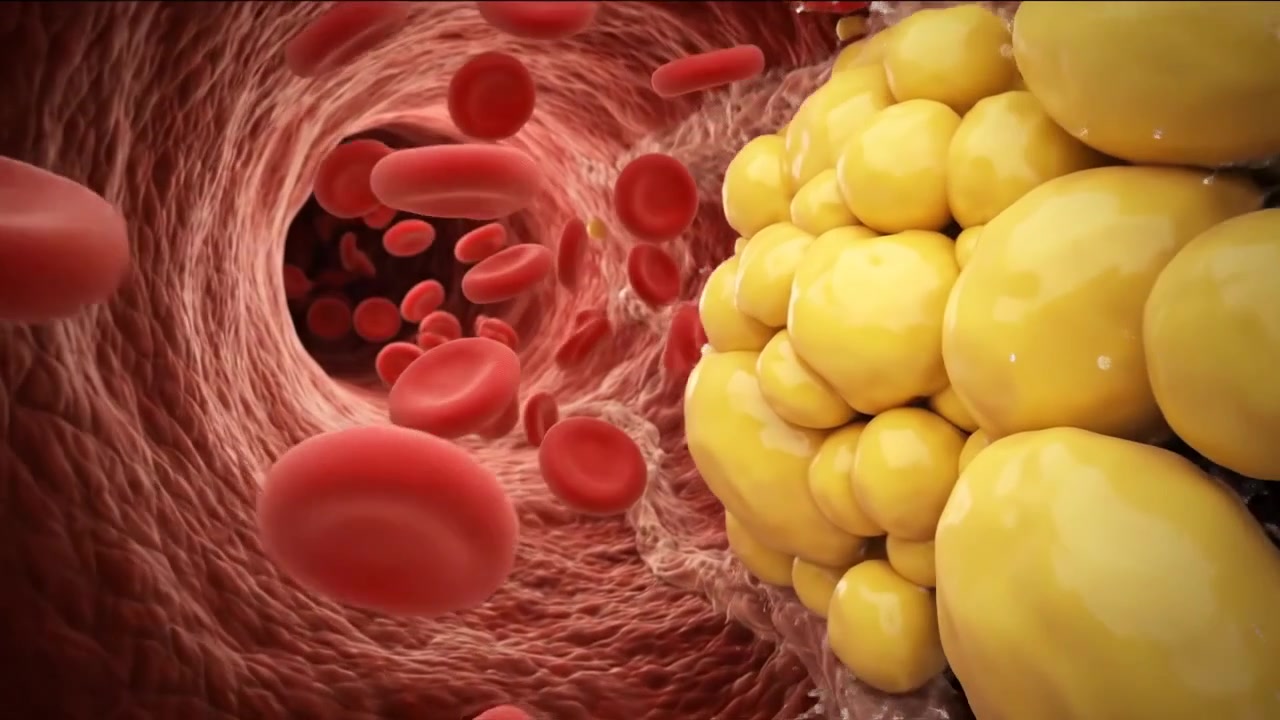 Visão microscópica do fluxo sanguíneo arterial e depósitos de lipídios