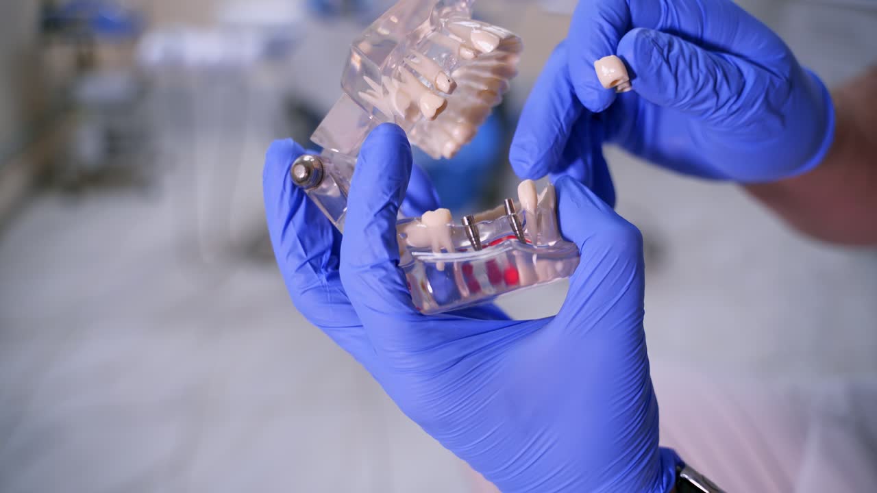 Doctor shows fake implants on a plastic jaw sample or model. Modern dental clinic background. Blue medical gloves on doctor's hands. Dental Hygiene and Health concept video. Implants in jaw.