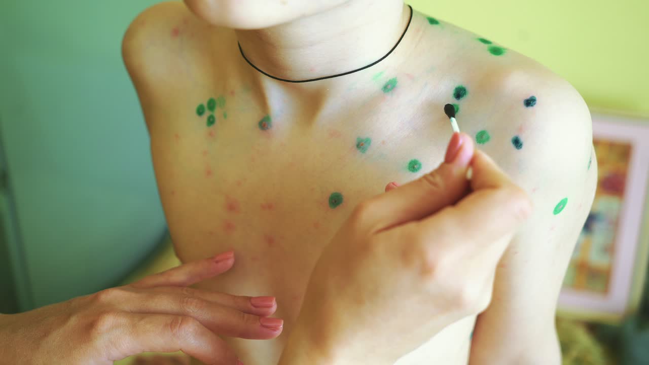 Little boy with chickenpox. Mother applying antiseptic solution to rash. Home treatment.