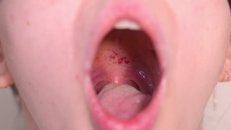 a lady opens her mouth to examine her throat rash - close up