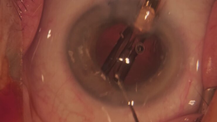 Macro footage of Eyes During Eye Surgery. Ophthalmological surgery.