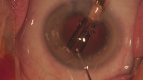 macro footage of eyes during eye surgery. ophthalmological surgery.