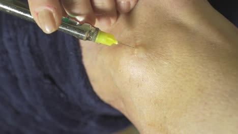 Close-up of a small medical needle injecting anaesthesia into a patient&#039;s knee and exiting the skin after the procedure is complete