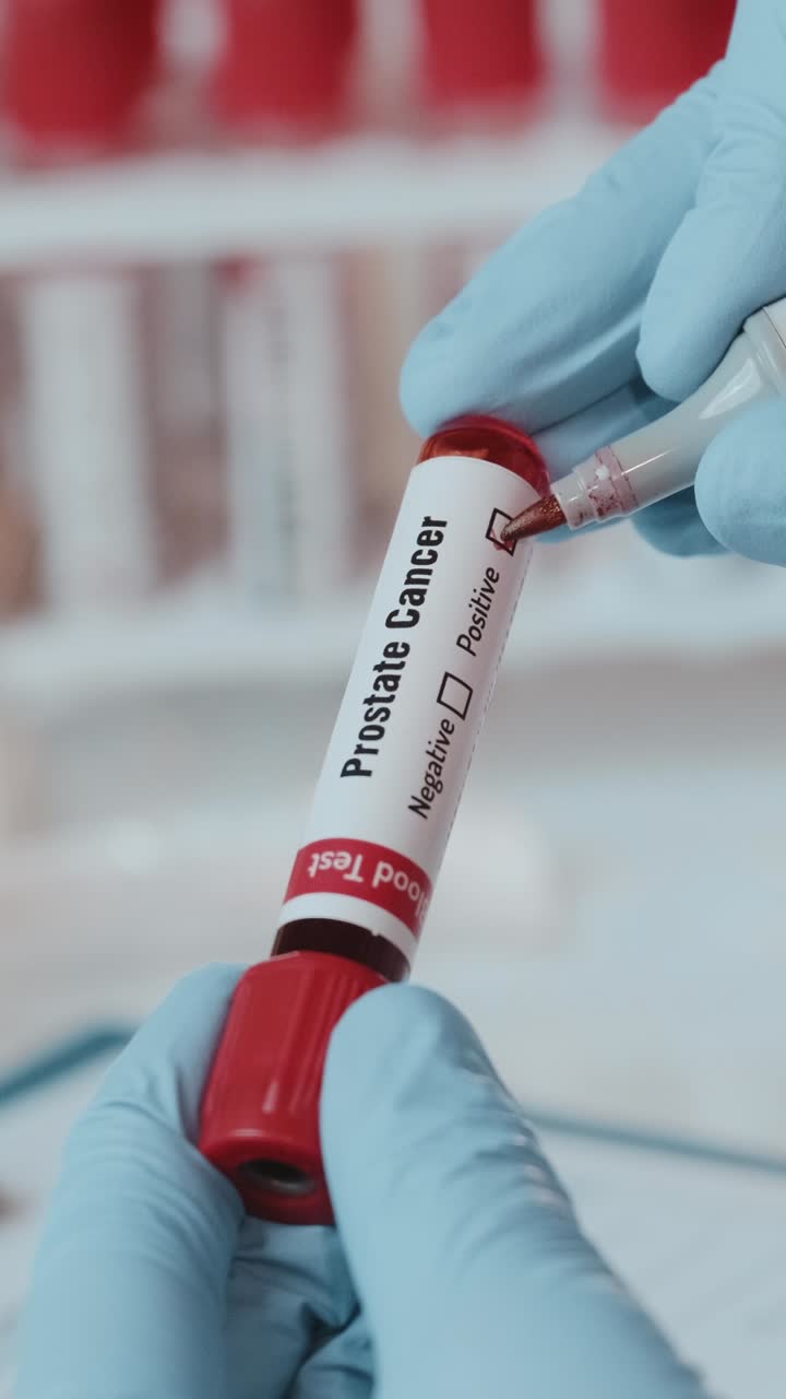 el profesional de la salud realiza un análisis de sangre para el diagnóstico de cáncer de próstata