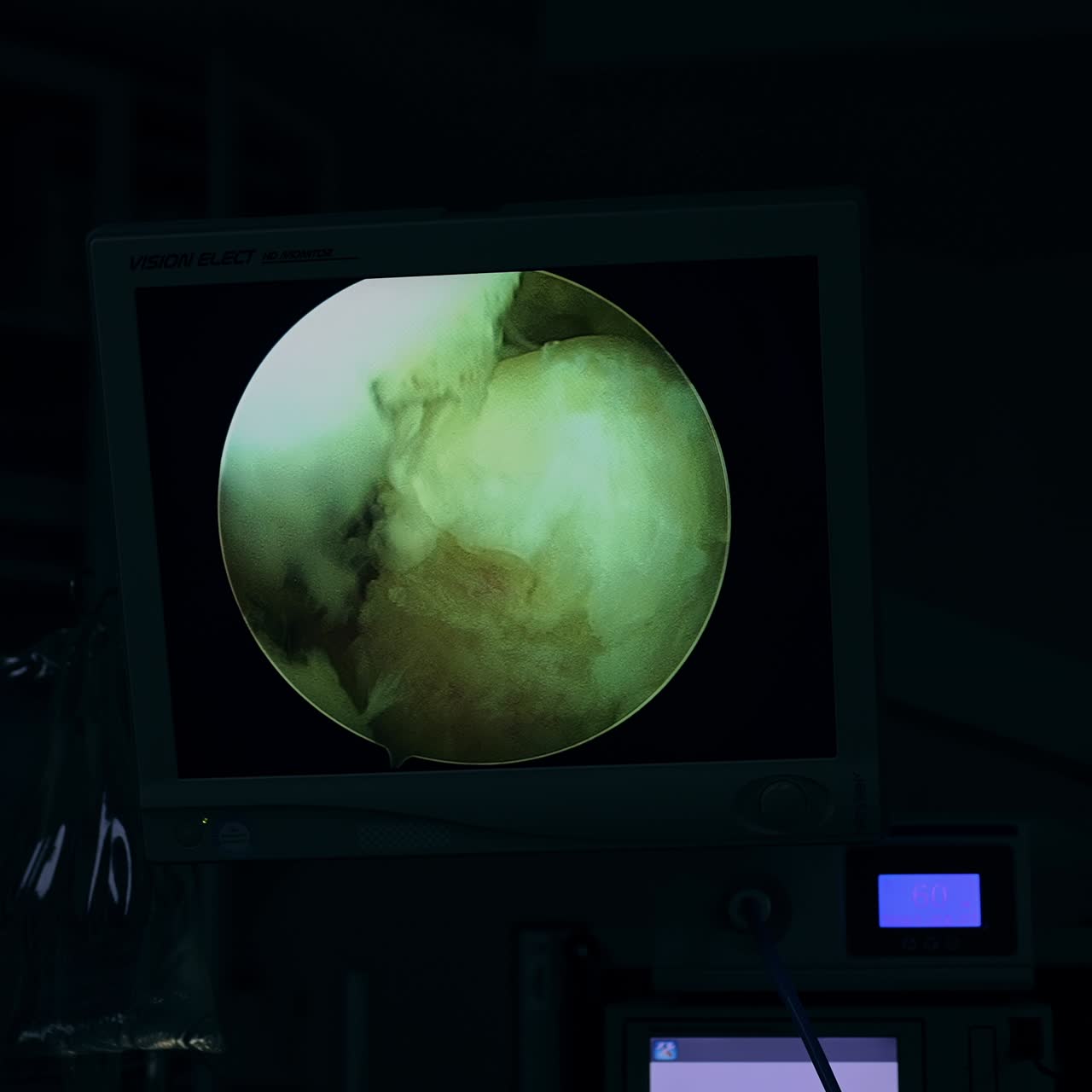 Enlarged image of laparoscopic tools work on the screen during surgery. Operational procedure conducted at the dark surgical room