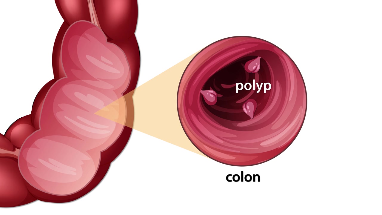 Animation illustrating colon anatomy, focusing on polyp detection and prevention of colon cancer through early intervention