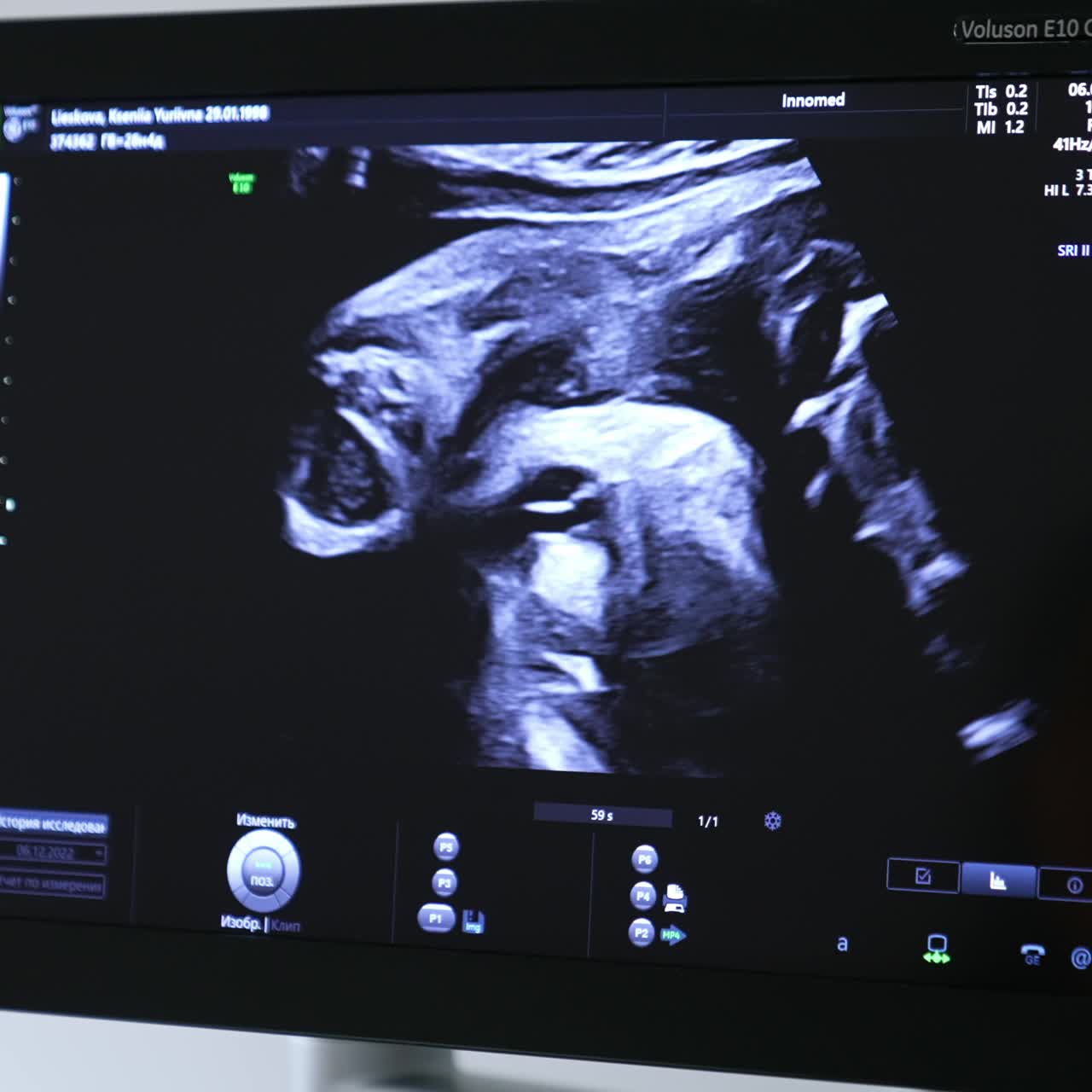 Screen of an ultrasound machine during the pregnant female check. Sonogram diagnostics for prenatal baby development