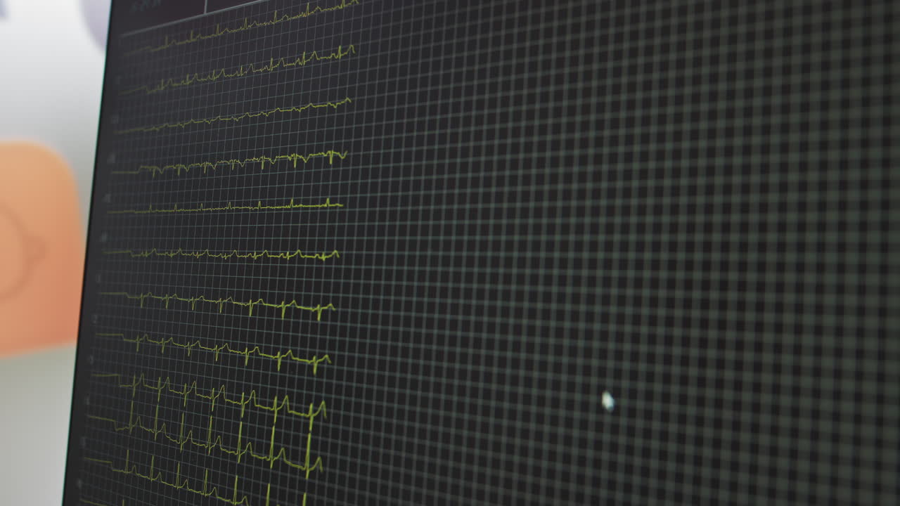 Monitor de frecuencia cardíaca en el quirófano de un hospital, instrumento de control de las constantes vitales en un hospital