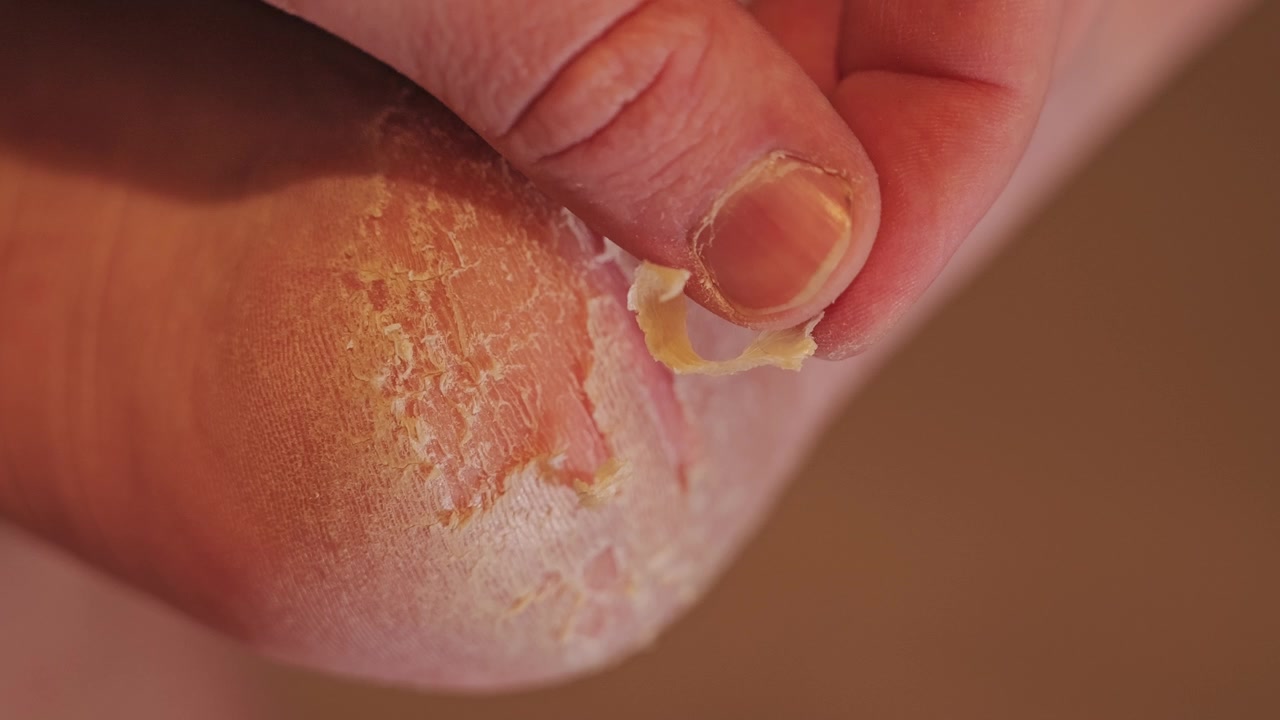 Extreme macro, peeling hyperkeratotic heel exposing cracked skin, tissue layers