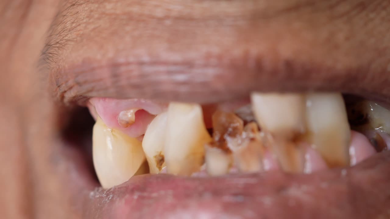 Close up of senior womens dental caries and some broken teeth