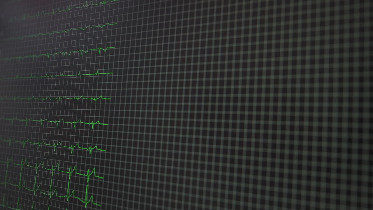 Patientmonitoren viser vitale tegn, EKG (elektrokardiogram) og iltmætning (SpO2).