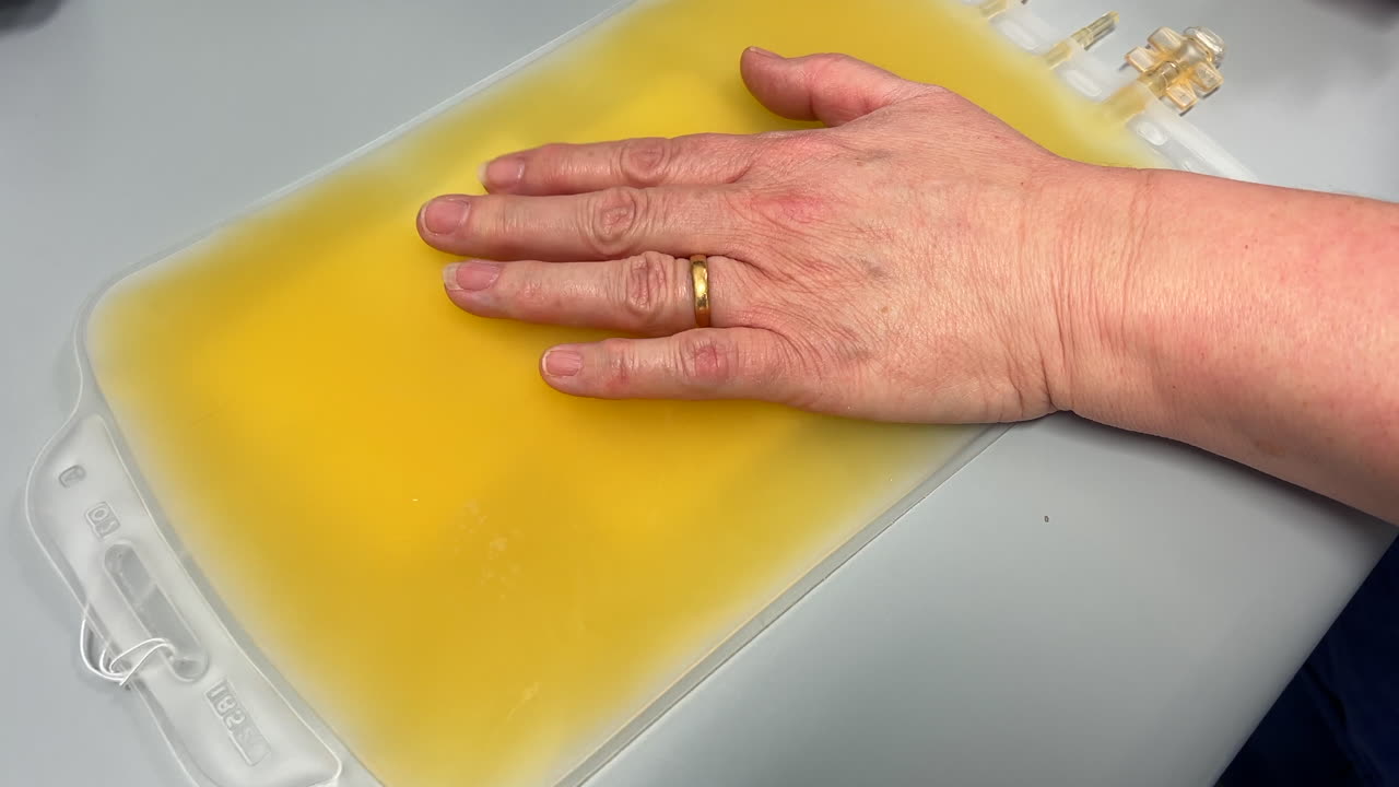 un grupo de plaquetas humanas en una bolsa, listo para transfusión, mantenido agitado hasta que esté listo para usarse en un paciente