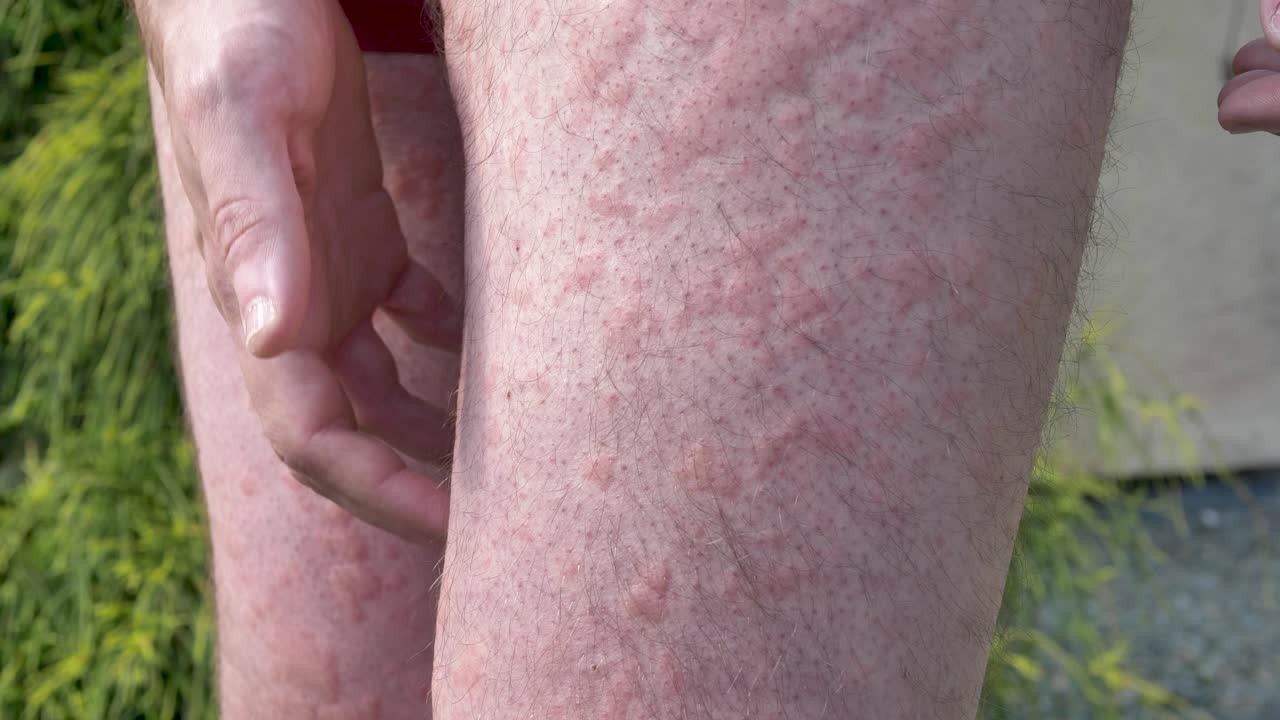 hombre caucásico picazón erupción de urticaria en las piernas