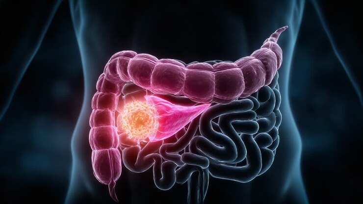 Anatomical Visualization of the Human Gastrointestinal System Highlighting Cancerous Cells in the Pancreas and Surrounding Organs for Educational Purposes