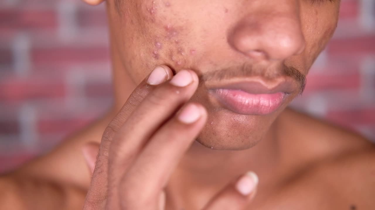 cerca de la cara de un joven con acné