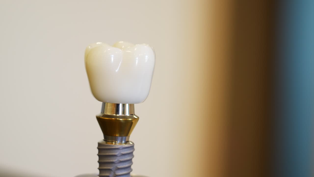 Close-up of a dental implant model on display