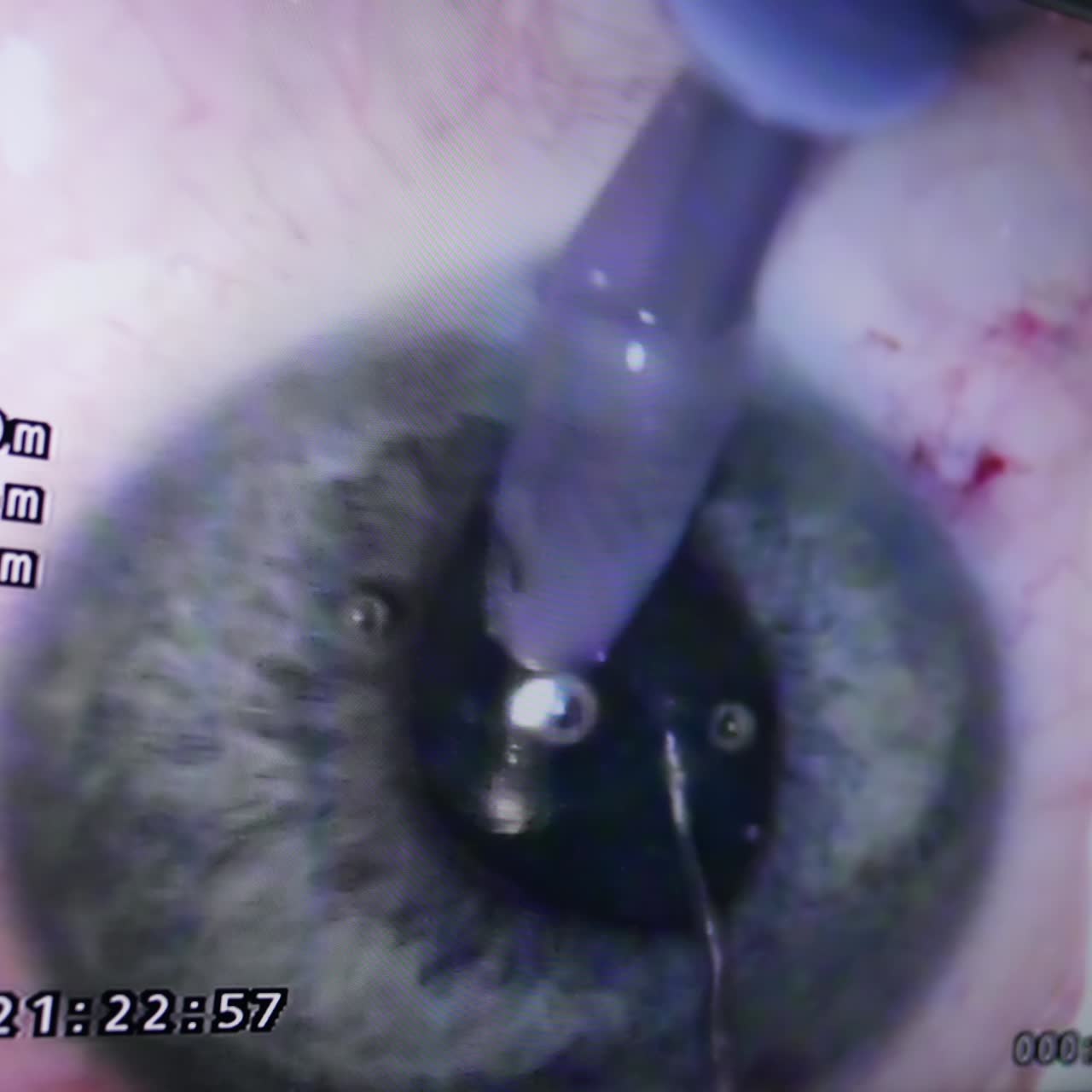 Eyesight surgery shown at the big screen at operational room. Sharp instruments are input into eyeball of a patient