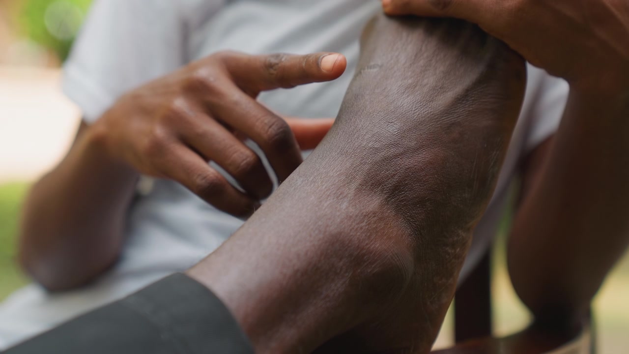Appuntamento al tramonto con il partner di colore, ispezione della pelle delle gambe, tocco tenero e rassicurante sulle zone secche, conversazione calma e gesto di supporto all'aperto, primo piano della pelle con texture e mani confortanti.