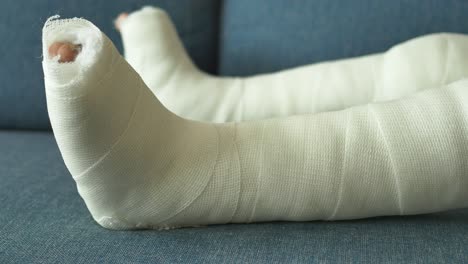 broken leg in cast