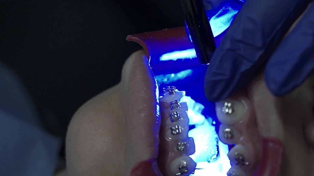 Dentista che utilizza una lampada polimerizzante per controllare l'apparecchio ortodontico di un paziente