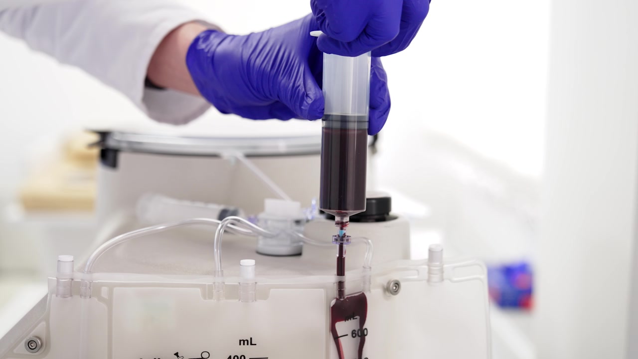 Mani con guanti in lattice blu che trasferiscono sangue da una grande siringa nel dispositivo centrifugo. Preparazione per la separazione del plasma dal sangue. Primo piano.