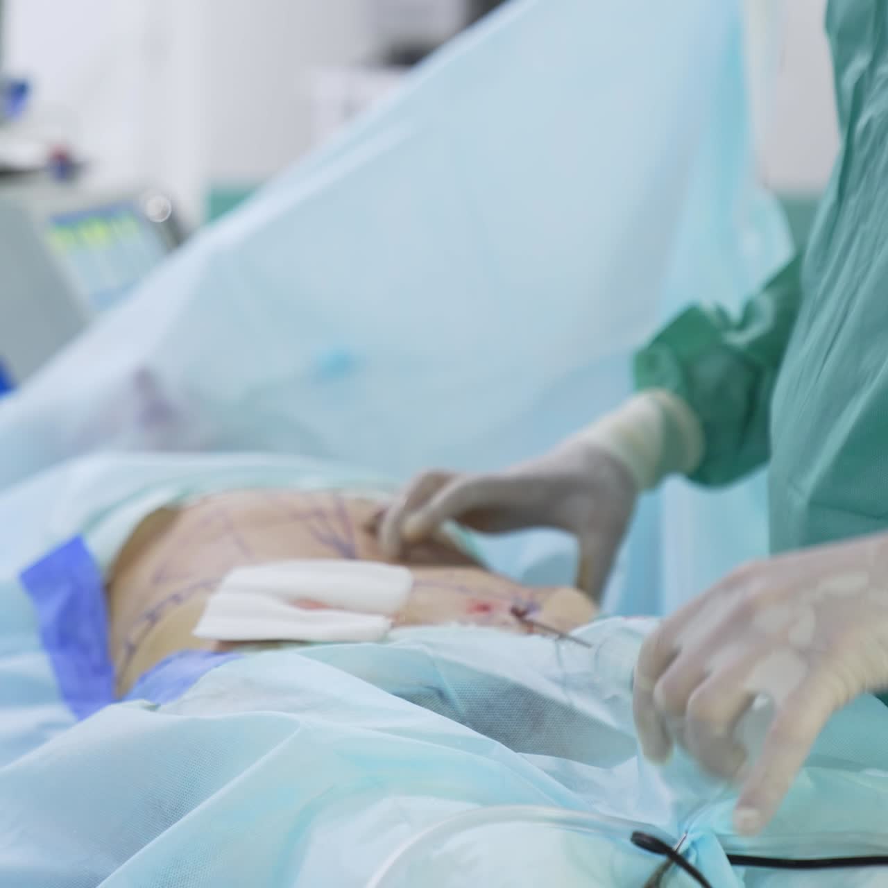 Liposuction procedure in clinic. Patient under anesthesia lying on operating table during surgery. Doctor's hands with surgical tool removes fat in patient's body