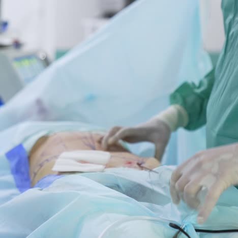 liposuction procedure in clinic. patient under anesthesia lying on operating table during surgery. doctor's hands with surgical tool removes fat in patient's body