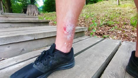 a man with an injured leg stands in the woods on a wooden stair