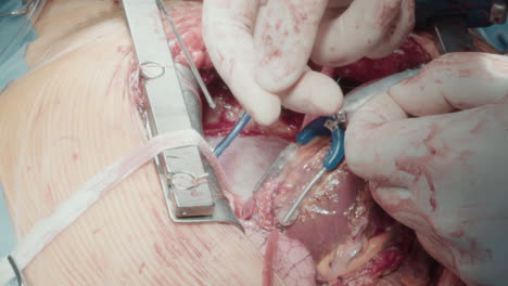el cirujano utiliza hilo para fijar el injerto. la mano del médico utiliza cuidadosamente suturas especializadas trabajando en la cavidad torácica abierta del paciente en la sala de operaciones de cerca