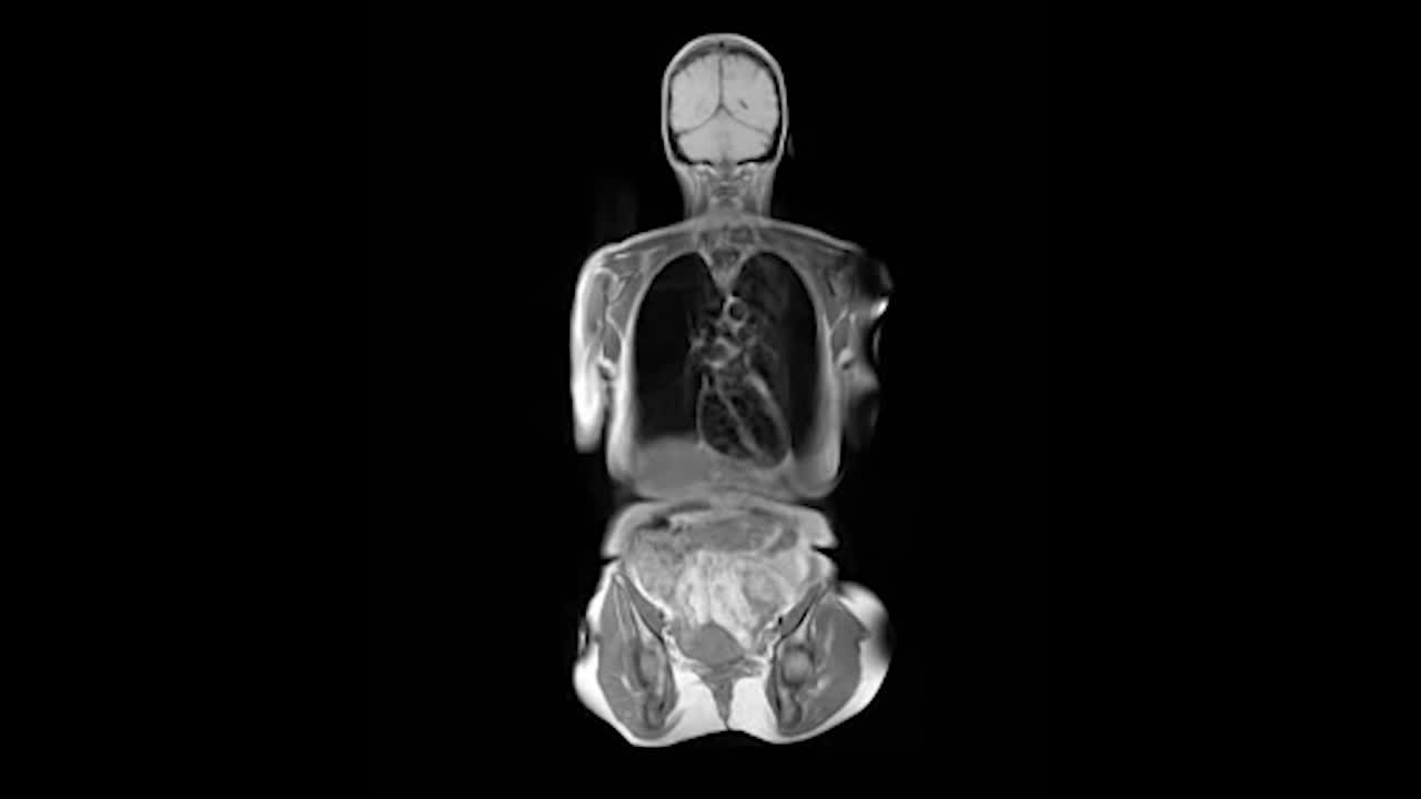 resonancia magnética, resonancia magnética de todo el cuerpo femenino.