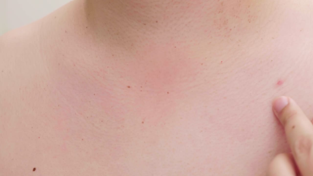 피부 문제 여드름과 큰 못생긴 간단한 클로즈업