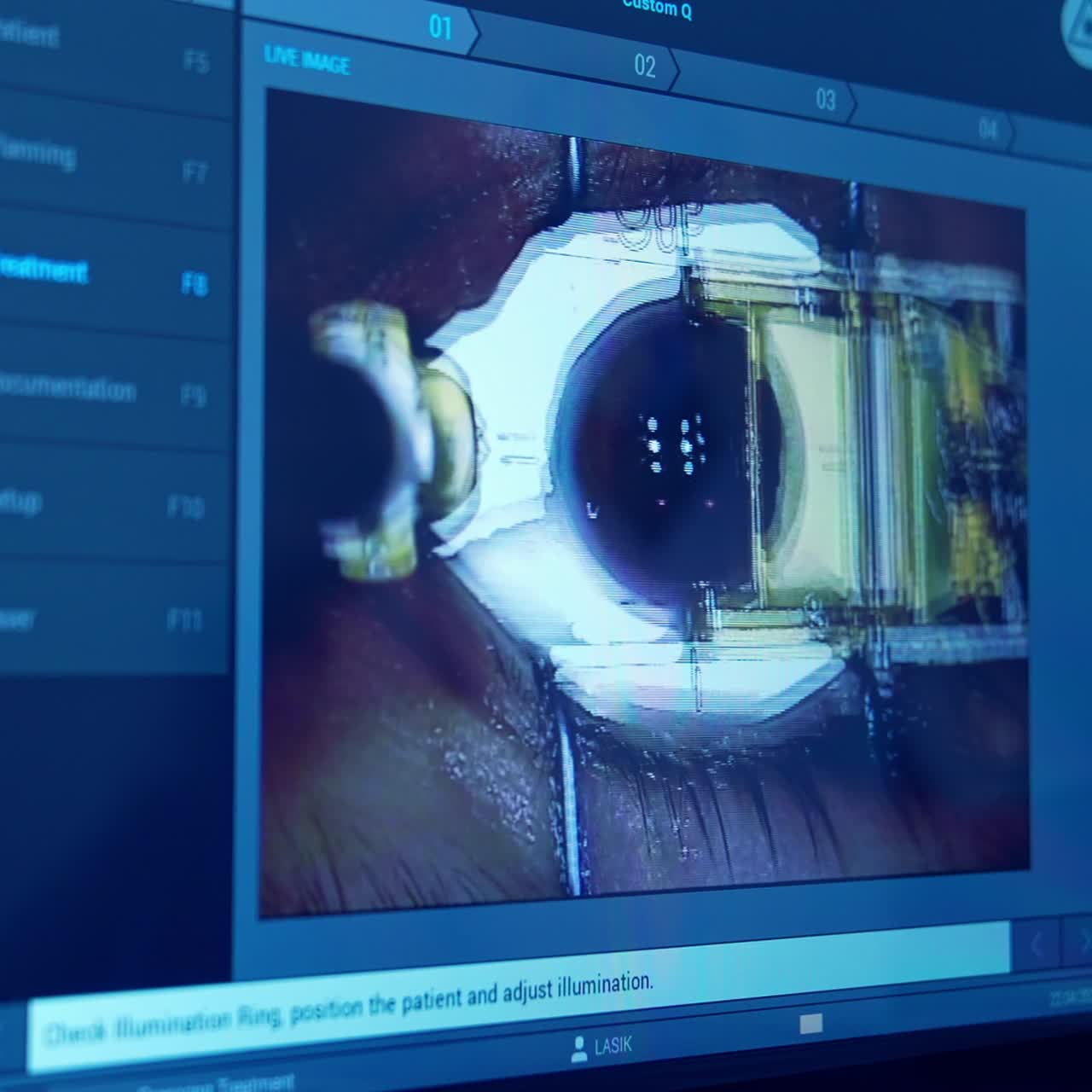 Laser eye treatment on a screen of a monitor. Computer monitor with eye surgery. Ophthalmological procedure of eye correction in clinic. Close-up