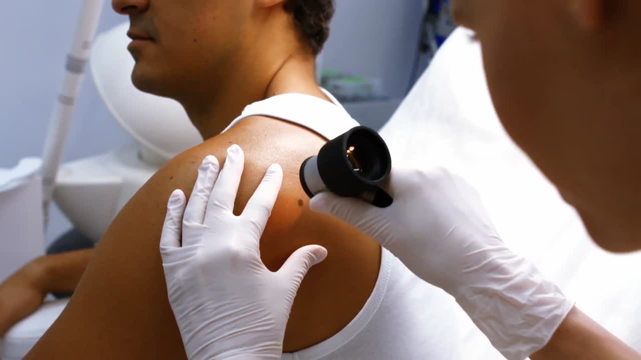 médico eliminando el lunar con tratamiento con láser