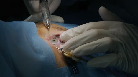 laser vision correction. a patient and team of surgeons in the operating room during ophthalmic surgery. eyelid speculum. lasik treatment. patient under sterile cover