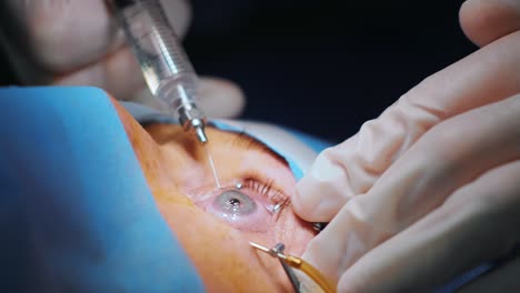 laser vision correction. a patient and team of surgeons in the operating room during ophthalmic surgery. eyelid speculum. lasik treatment. patient under sterile cover