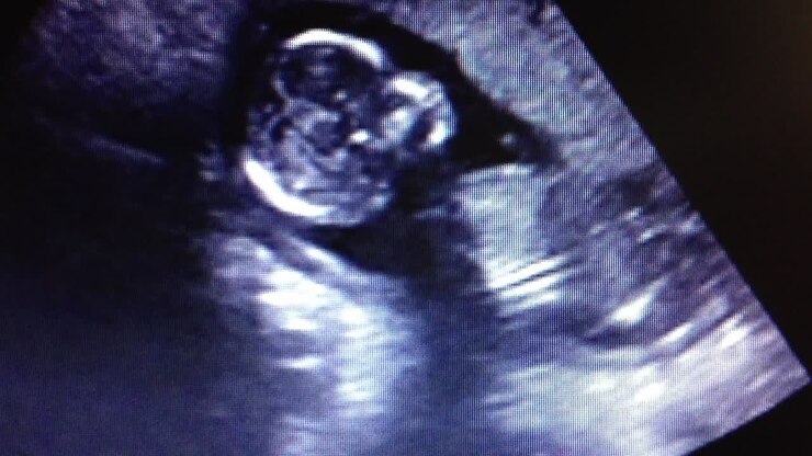 Ultrasound sonogram of a human fetus developing in the mother's womb.