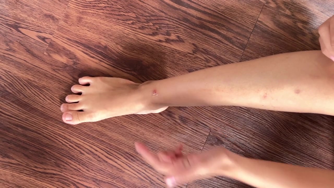 Close up 4K handheld top view of a woman applying antiseptic cream to a blister on her foot Patient self treating skin at home first aid skincare medical treatment and health care concept