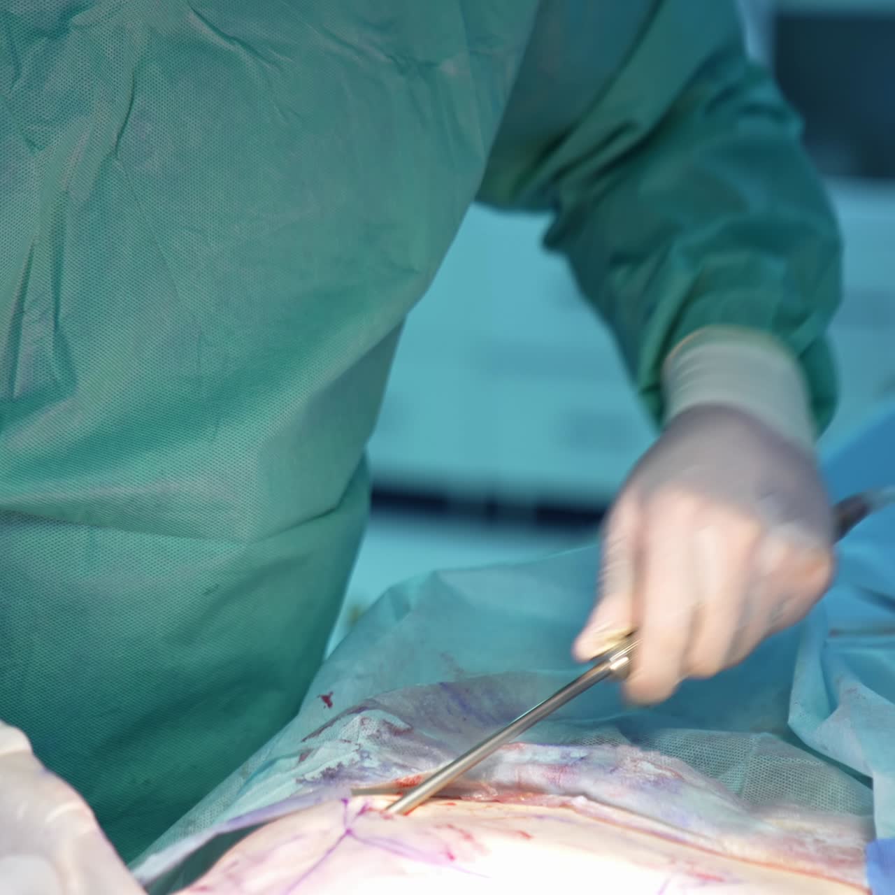 Surgeon gathering fat from patient's abdomen. Liposuction procedure by professional doctor. Filtration and pumping fat in the operating room