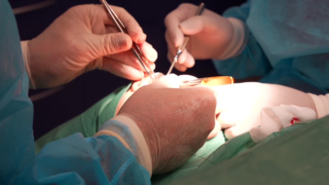 Odontologist with transparent gloves uses tweezers for dental prosthesis operation. Close up
