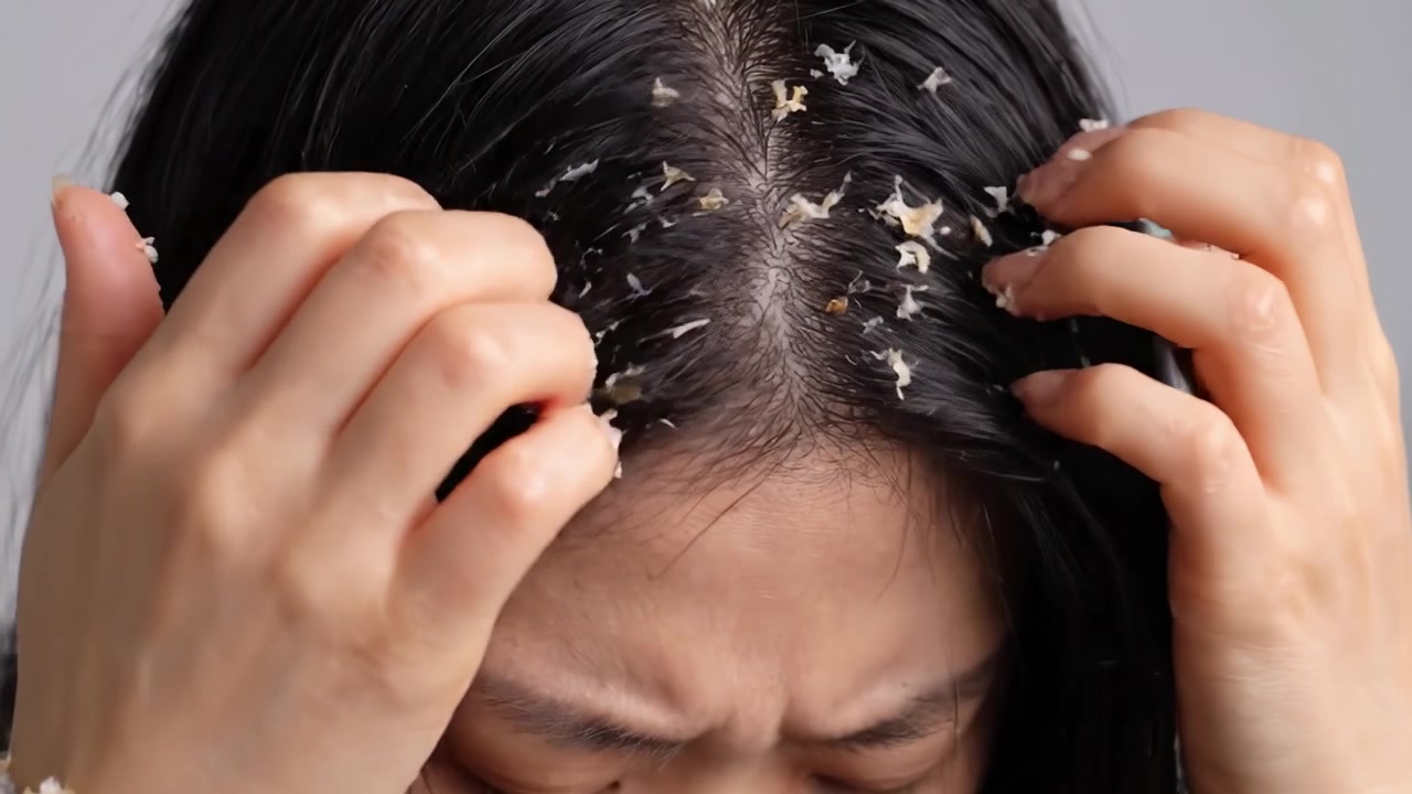 Exploring Hair Care Challenges: A Close Look at the Effects of Scalp Issues on Confidence and Well-being in Personal Grooming