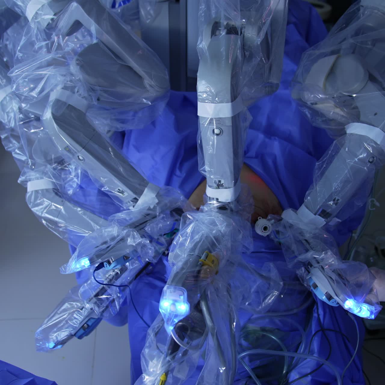 Operating robotic equipment in the contemporary clinics. Unrecognized surgeon standing by the apparatus performing abdominal surgery. High angle view