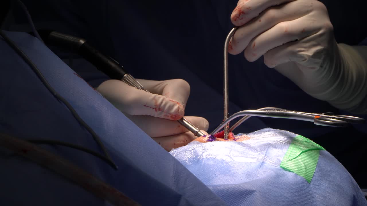 일반적으로 뇌 수술로 알려진 신경 외과 또는 신경 외과는 외과 적 치료와 관련된 의료 전문 분야입니다.