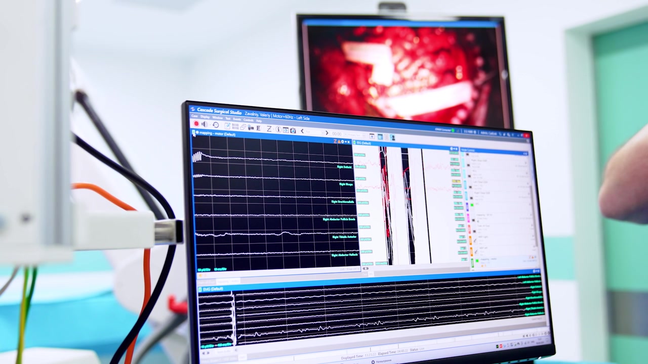 Monitor del computer con onde cerebrali in movimento. Lo schermo sullo sfondo mostra il cervello operato. Operazione di neurochirurgia