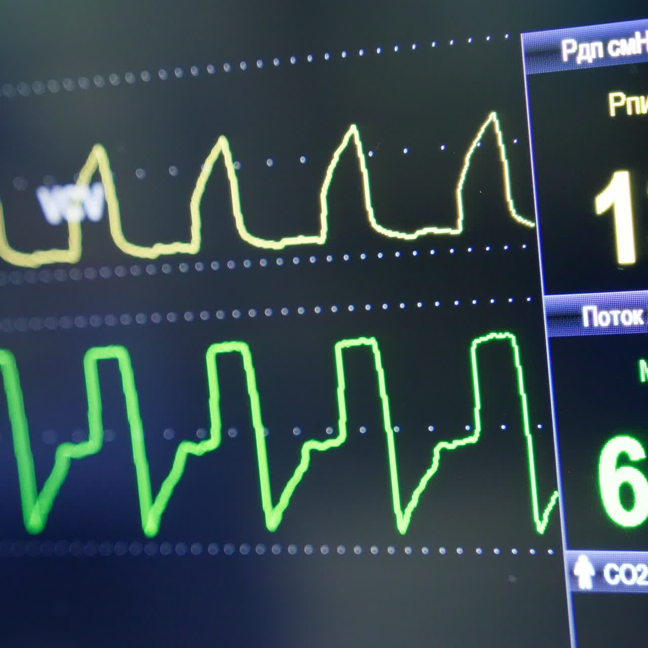 Black screen with moving curves on. Life parameters of a patient shown at the monitor during surgical operation. Close up