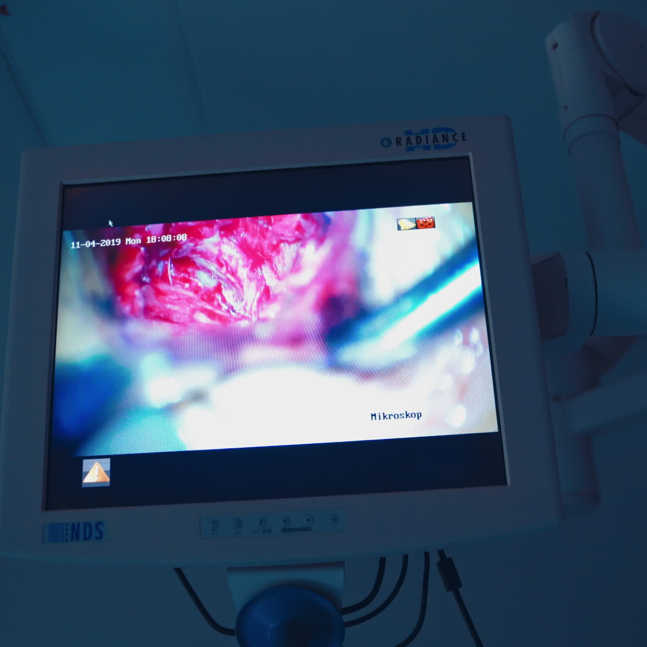 New technology in surgery. Operating process is shown on the screen of a monitor. Close-up shoot of endoscopic surgery on display.