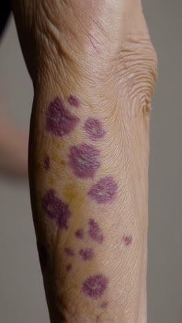 purple spots on elderly person's arm