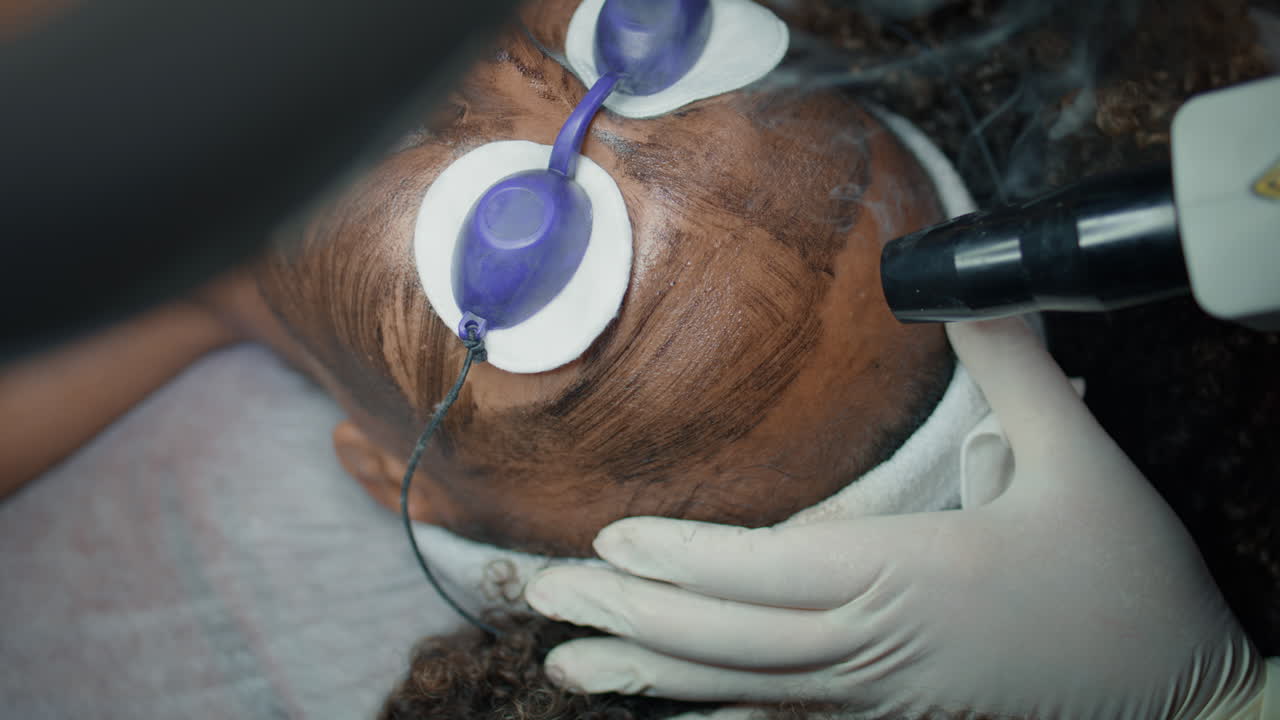 Closeup laser pulsing face in beauty clinic.Cosmetologist do carbon peeling